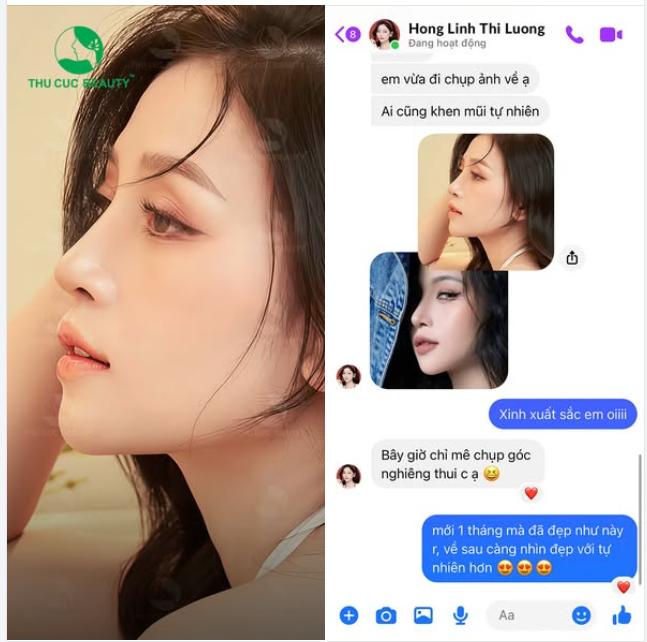 Feedback hài lòng, ưng ý sau Nâng mũi của KH Hồng Linh