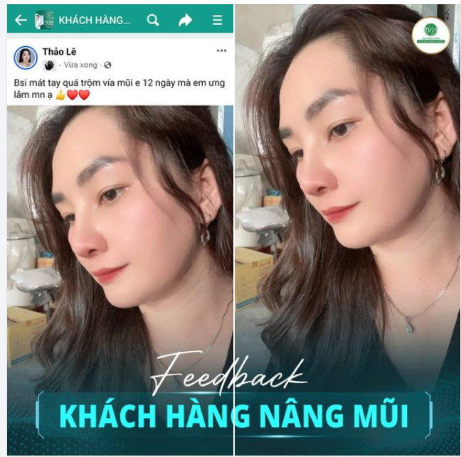 FEEDBACK SAU 12 NGÀY NÂNG MŨI