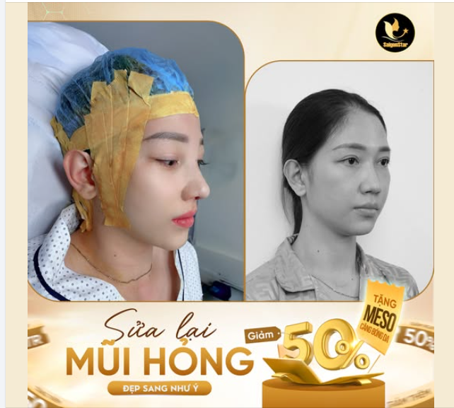 SỬA LẠI MŨI HỎNG - ĐẸP SANG NHƯ Ý  NÂNG MŨI SỤN SƯỜN - GIẢM 50% TẶNG MESO CĂNG BÓNG DA