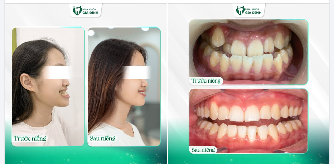 THAY ĐỔI GÓC NGHIÊNG HOÀN HẢO NHỜ NIỀNG RĂNG