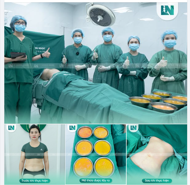 Ekip Bác sĩ Lương Ngọc đã thành công giúp bạn khách hàng 8x trút bỏ gánh nặng “mỡ thừa” ở vòng bụng.