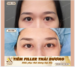 TIÊM FILLER THÁI DƯƠNG - TRẺ TRUNG, HÀI HÒA CHỈ TRONG 15 PHÚT