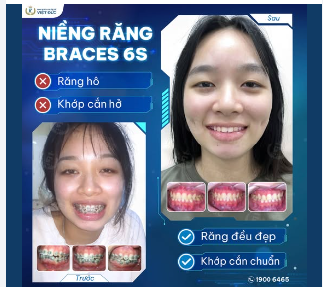 MỪNG NGÀY THÁO NIỀNG: KHÁCH HÀNG BÙI THỊ HƯƠNG GIANG  RĂNG HÔ, KHỚP CẮN HỞ KHÔNG CÒN LÀ NỖI LO CHỈ SAU 18 THÁNG