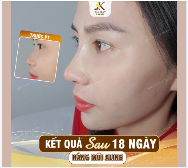 THAY ĐỔI DÁNG MŨI - TỎA SÁNG TỰ NHIÊN