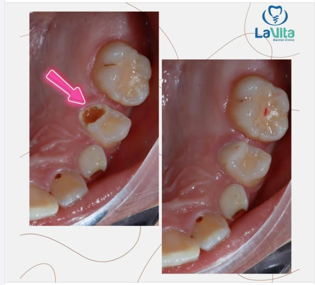 SÂU RĂNG: NGUYÊN NHÂN, DẤU HIỆU VÀ CÁCH ĐIỀU TRỊ