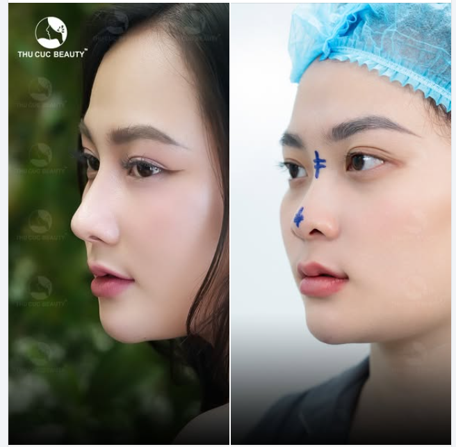 Xóa sổ tình trạng mũi thấp tẹt cho bạn gái cùng Mũi TC
