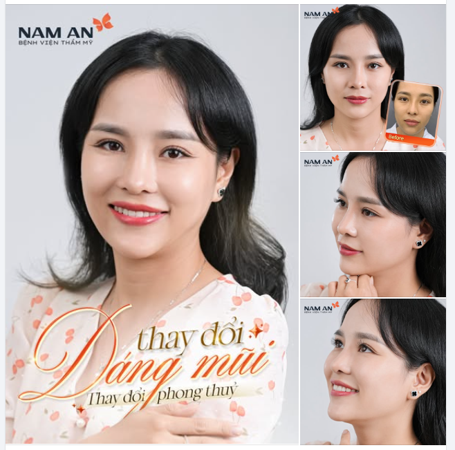 SỬA MŨI HỎNG - ĐỔI VẬN PHONG THỦY CÙNG NAM AN