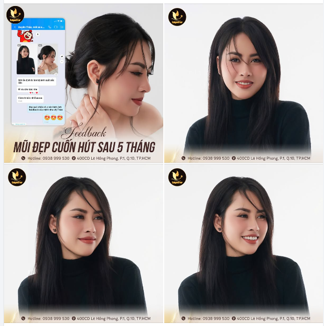 FEEDBACK SAU 5 THÁNG NÂNG MŨI CẤU TRÚC  MŨI ĐẸP CUỐN HÚT - TỰ TIN MỌI GÓC HÌNH
