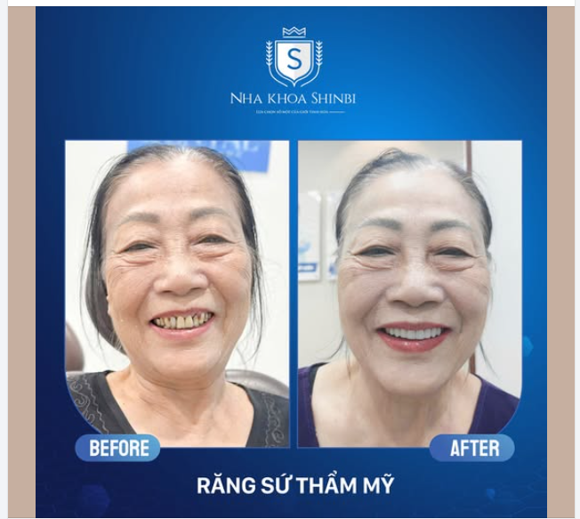 TRỒNG RĂNG IMPLANT AN TOÀN - GIẢI PHÁP CHO NHỮNG NỤ CƯỜI KHIẾM KHUYẾT