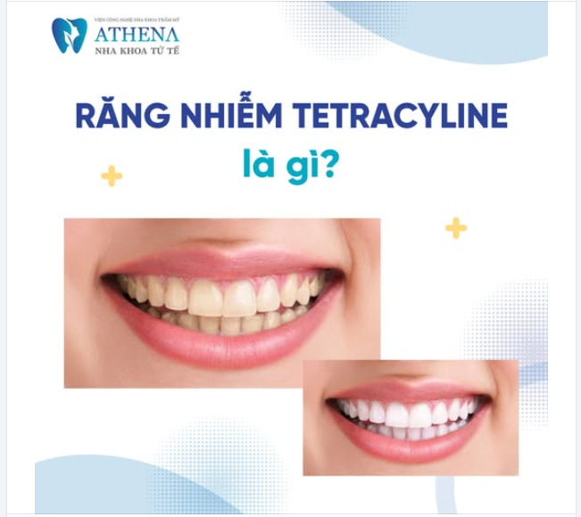 THẨM MỸ RĂNG SỨ - GIẢI PHÁP HOÀN HẢO CHO RĂNG NHIỄM MÀU