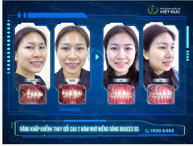 MỪNG NGÀY THÁO NIỀNG: KHÁCH HÀNG NGUYỄN HƯƠNG TRANG️