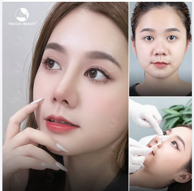 Chọn Mũi TC - Xóa bỏ tự ti mũi thấp, đầu mũi to