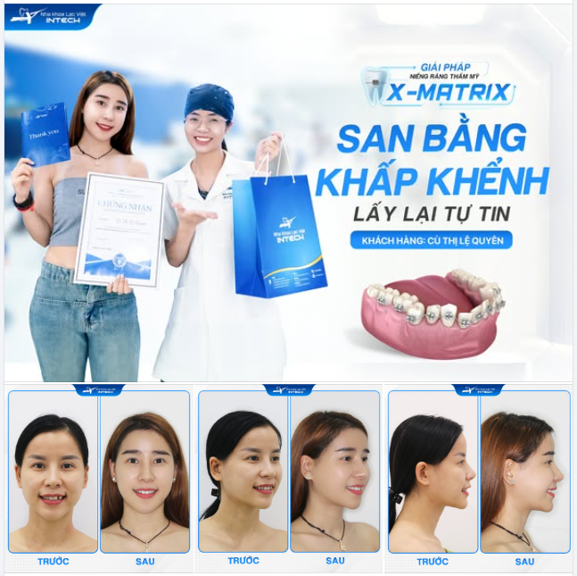 SAN BẰNG KHẤP KHỂNH - THĂNG HẠNG NHAN SẮC NHỜ NIỀNG RĂNG X-MATRIX!