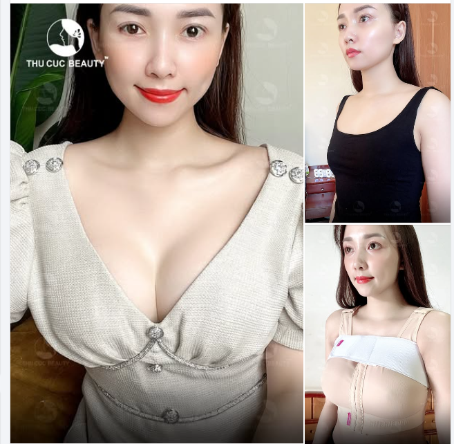 ​​​​​​​Nâng ngực xong  Tự tin thả dáng, diện mọi trang phục