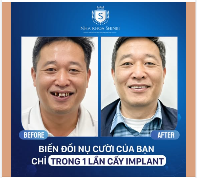 TRỒNG RĂNG IMPLANT - LÀM RĂNG TRƯỚC TRẢ TIỀN SAU