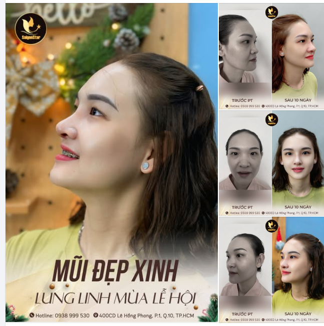 NÂNG MŨI CẤU TRÚC - HỒI PHỤC NHANH - ĐẸP KỊP TẾT