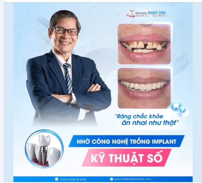 Răng chắc khỏe, ăn nhai như răng thật nhờ trồng răng implant kỹ thuật số