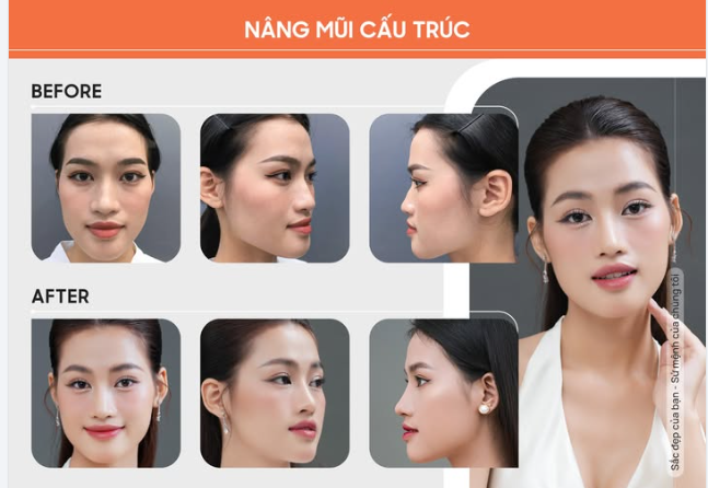 Á HẬU MINH THƯ SỞ HỮU DÁNG MŨI CAO THANH TÚ SAU NÂNG MŨI