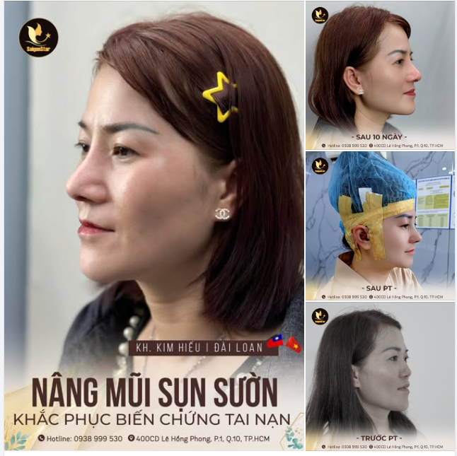 HÔ BIẾN MŨI ĐẸP CHUẨN FORM - CẢI THIỆN MŨI HỎNG SAU TAI NẠN