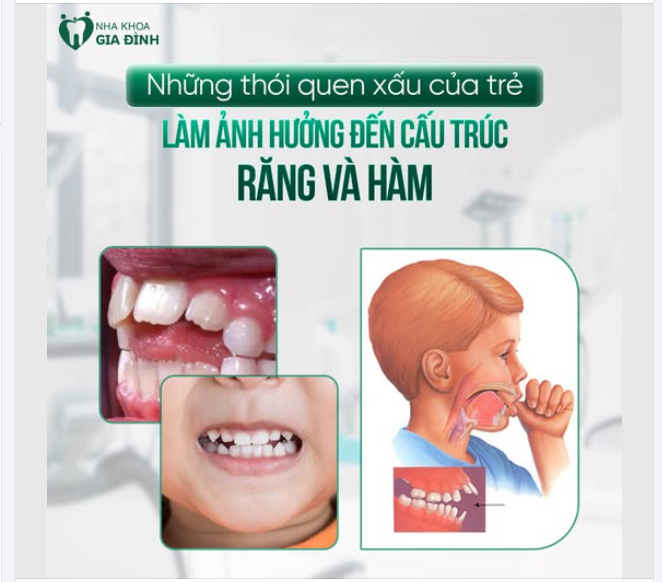 NHỮNG THÓI QUEN XẤU ẢNH HƯỞNG ĐẾN QUÁ TRÌNH CHỈNH NHA