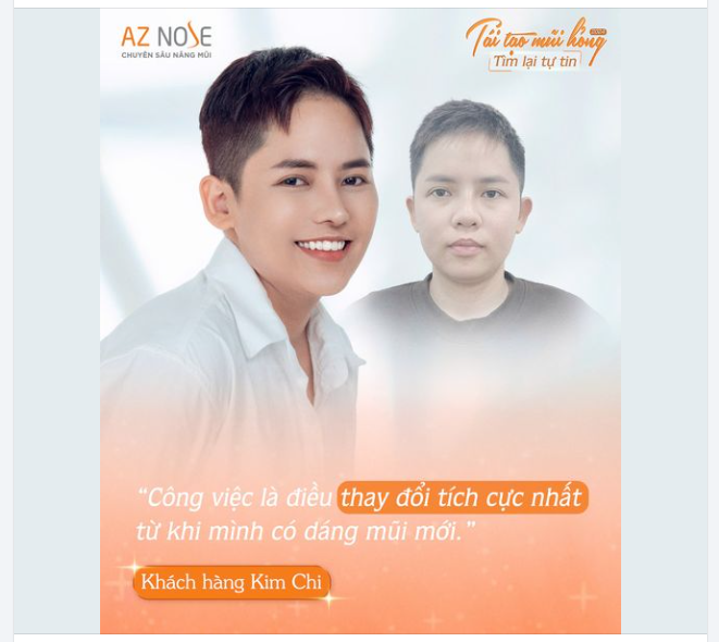Tìm lại tự tin sau 4 tháng tái tạo dáng mũi bởi BS CKI. Hoàng Nhung