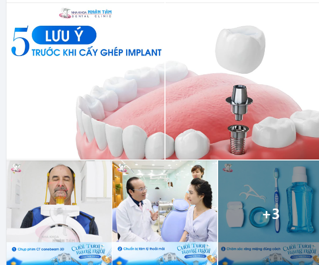 5 LƯU Ý TRƯỚC KHI CẤY GHÉP IMPLANT