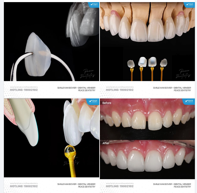 MẶT DÁN SỨ VENEER - MỎNG HẠN CHẾ XÂM LẤN CHO NỤ CƯỜI HOÀN HẢO