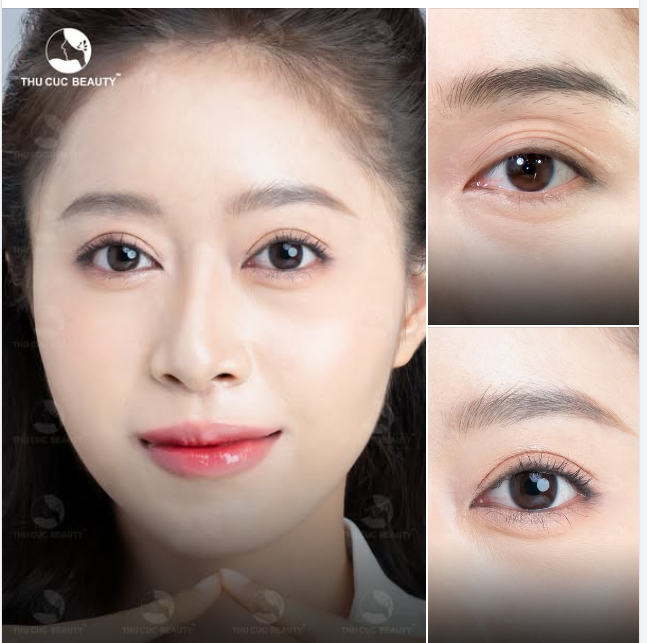 Cắt mí TC tuân thủ chặt chẽ Quy trình thực hiện an toàn, nhanh chóng, không cần nghỉ dưỡng. Sinh hoạt bình thường ngay khi PT xong.