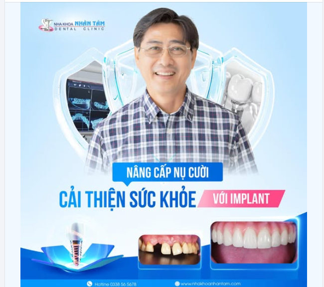 “Nâng cấp” nụ cười, cải thiện sức khoẻ với giải pháp cấy ghép implant