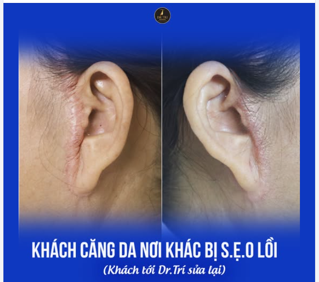 Nhìn xót quá mọi người, khách căng da nơi khác bị sẹo lồi,