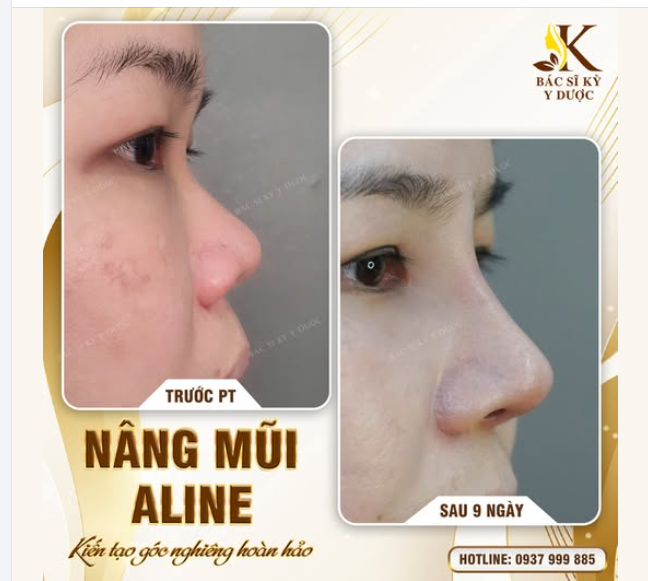 THAY ĐỔI GÓC NGHIÊNG CHỈ SAU 9 NGÀY NÂNG MŨI ALINE