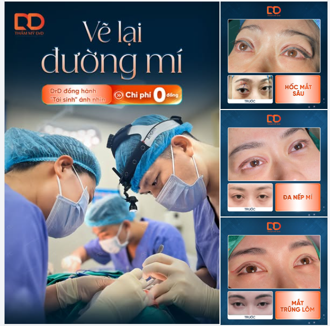VẼ LẠI ĐƯỜNG MÍ VỚI CHI PHÍ 0 ĐỒNG