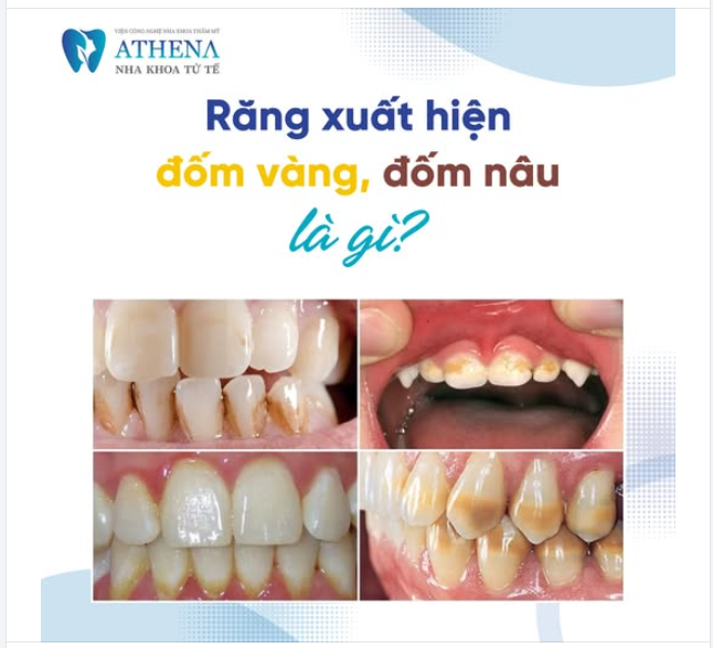 Răng xuất hiện đốm vàng và đốm nâu là gì?