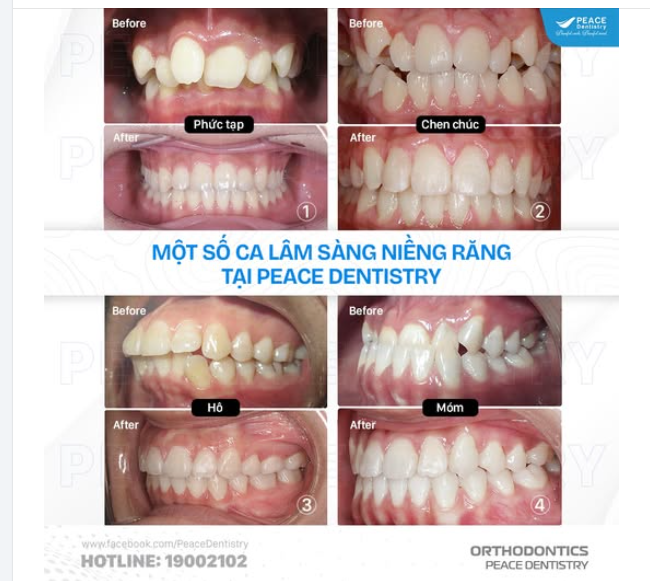 4 THÀNH CÔNG NỔI BẬT TRONG CHỈNH NHA PHỨC TẠP TẠI PEACE DENTISTRY