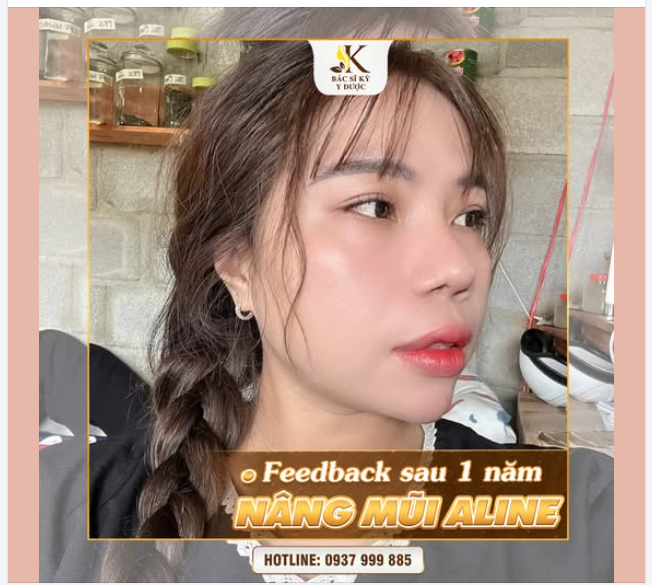 +1000 ĐIỂM TỰ TIN SAU KHI NÂNG MŨI ALINE