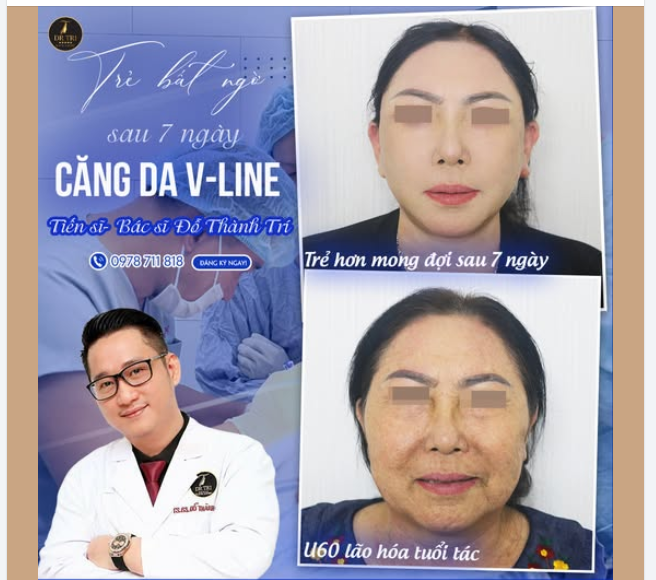 SỨC MẠNH CỦA PHẪU THUẬT CĂNG DA V-LINE!
