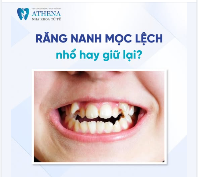 Răng nanh đóng vai trò quan trọng trong việc cắn, xé thức ăn và giữ thẩm mỹ hài hòa cho nụ cười.
