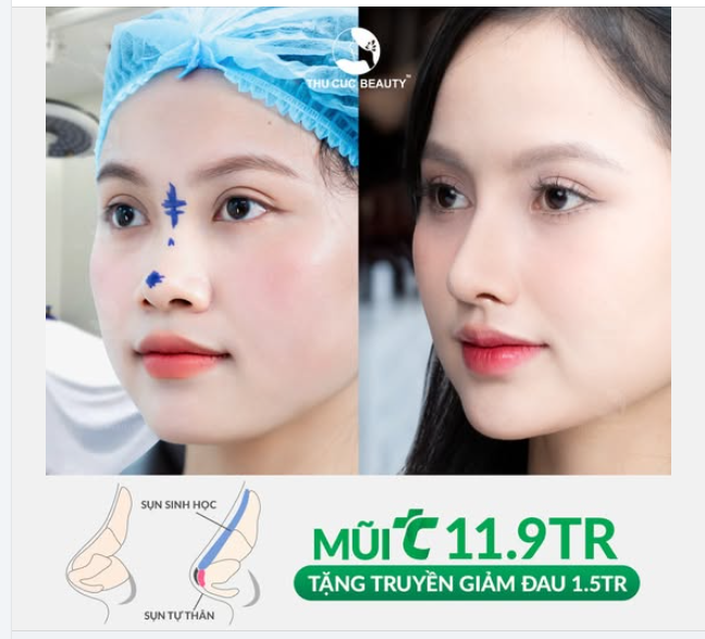 Muốn có mũi ưng ý hãy đến ngay TC