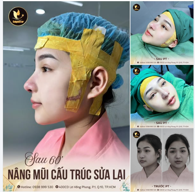 60 PHÚT MŨI HỎNG HOÁ ĐẸP CAO SANG