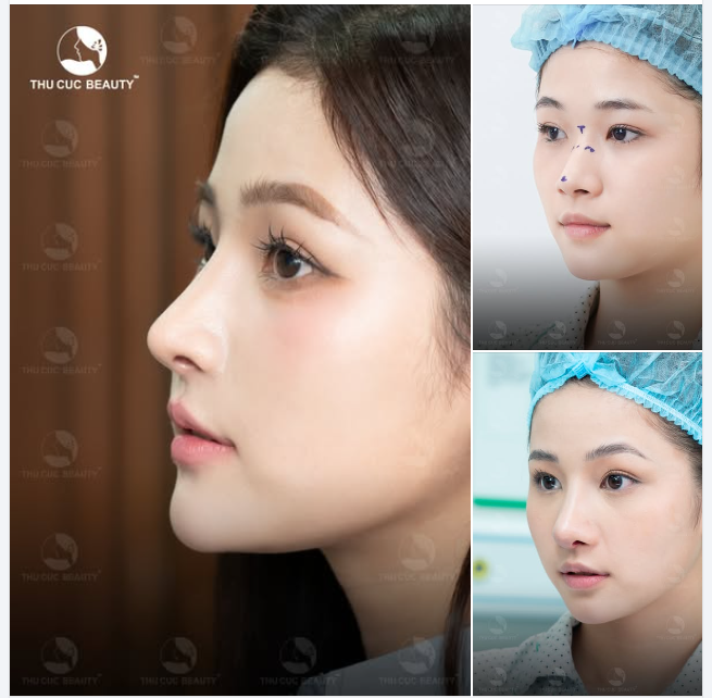 Chiếc mũi đẹp chuẩn không những cao bay mà còn phải tương thích cơ thể