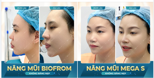 Xu hướng nâng mũi cấu trúc - KHÔNG BĂNG NẸP - La Ratio đánh dấu lối đi riêng trên thị trường.