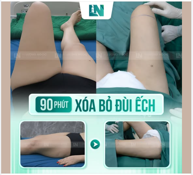 GIẢI QUYẾT NỖI LO ĐÙI TO CHO CHỊ KHÁCH 8X