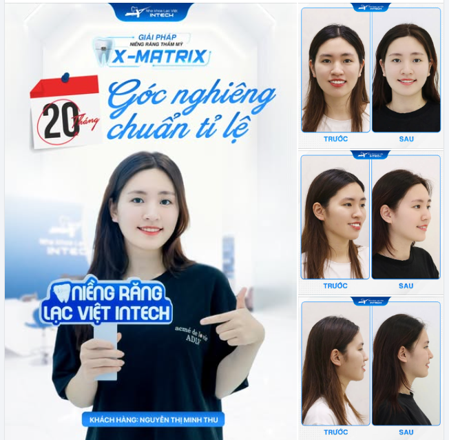 SỞ HỮU GÓC NGHIÊNG CHUẨN TỈ LỆ SAU 20 THÁNG NIỀNG RĂNG