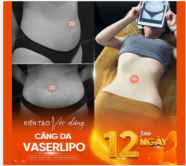 KẾT QUẢ SAU 12 NGÀY KIẾN TẠO VÓC DÁNG VỚI CÔNG NGHỆ VASERLIPO