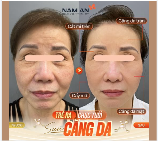 TRẺ RA CHỤC TUỔI SAU CĂNG DA