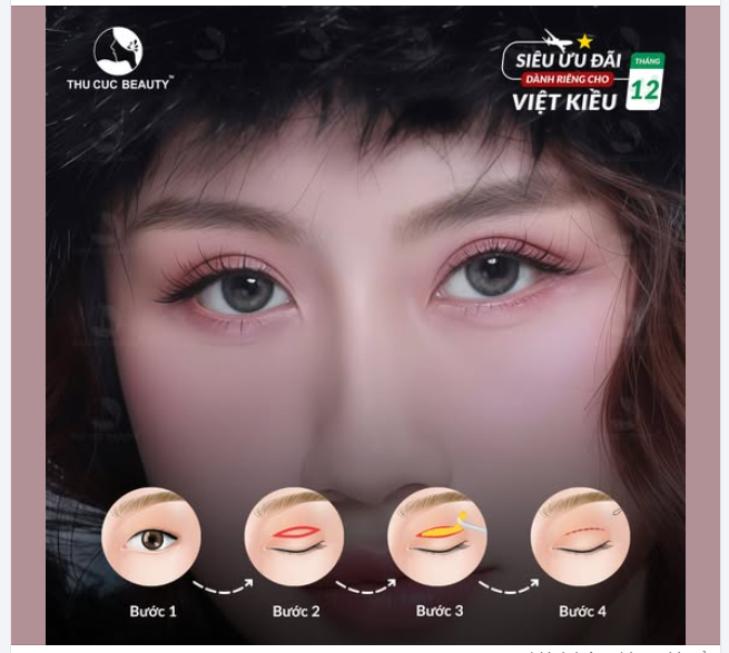 Nếp mí vào form nhanh chóng. Sẹo thẩm mỹ  Sở hữu đôi mắt to tròn, gương mặt sắc nét
