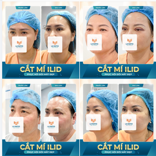Phục hồi lại đôi mắt của thanh xuân, thay đổi hình dáng đôi mắt 360 độ sau khi sử dụng dịch vụ cắt mí ILiD tại nhà La Ratio