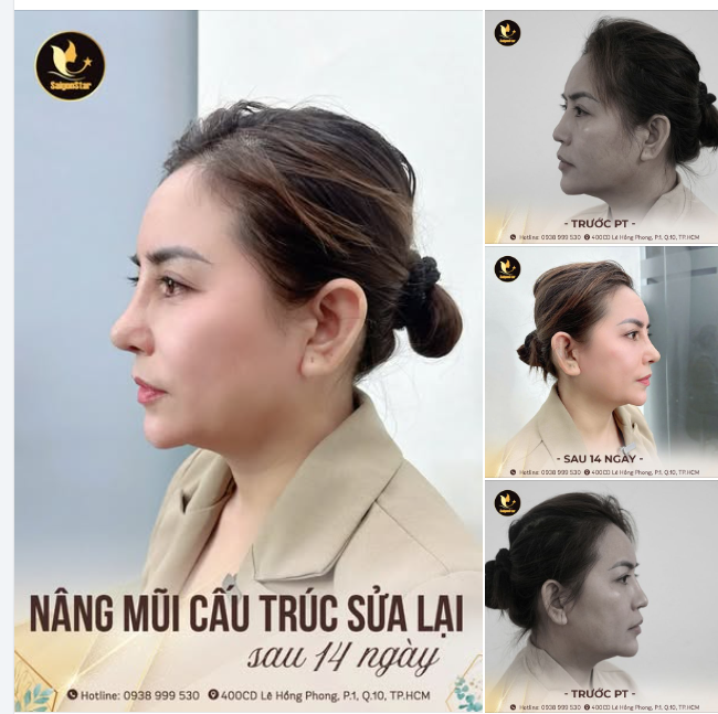 60 PHÚT KHẮC PHỤC KỊP THỜI CÁC BIẾN CHỨNG - 14 NGÀY MŨI ĐẸP CHUẨN FORM!!!