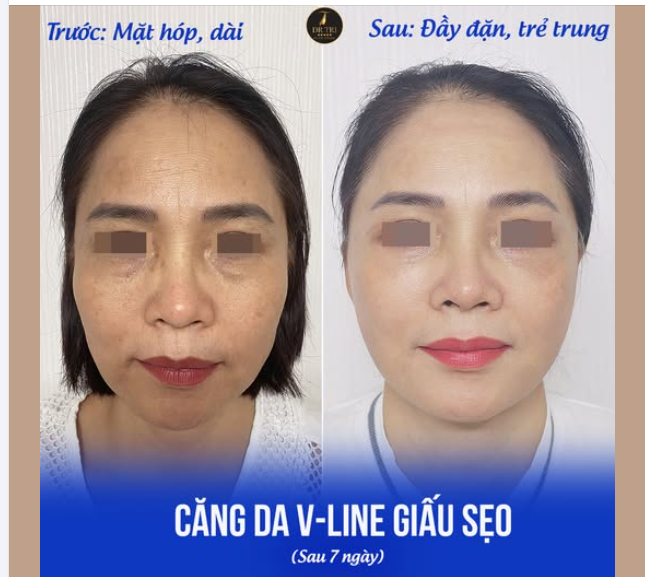 SỰ THẦN KỲ CỦA CĂNG DA V-LINE GIẤU SẸO với gương mặt dài hốc hác của chị khách