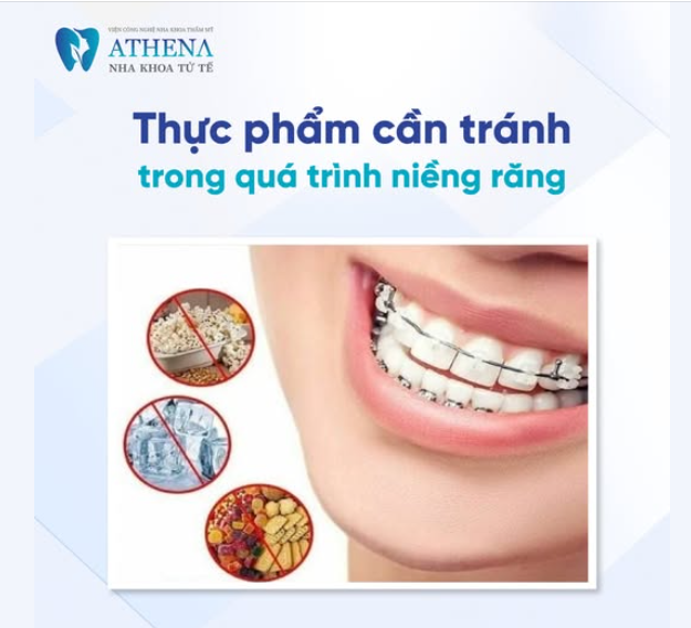 Niềng răng không chỉ yêu cầu sự kiên nhẫn mà còn cần thay đổi thói quen ăn uống để bảo vệ mắc cài và đạt được hiệu quả tốt nhất.